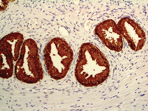 IHC of Prostate-Specific Antigen Mmab on an FFPE Prostatic Adenocarcinoma Tissue